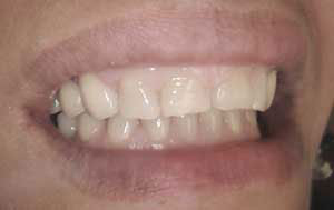RC After Dental Crowns and Bridges