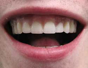 AN After Dental Implants