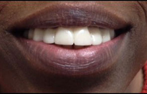 BC After Teeth-in-a-Day Dental Implants