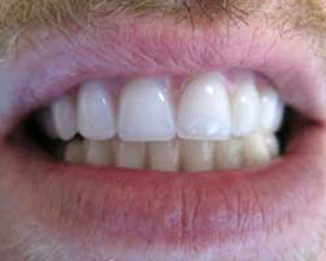 CE After Teeth-in-a-Day Dental Implants