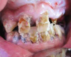 CE Before Teeth-in-a-Day Dental Implants
