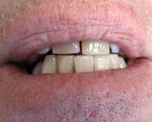 RD After Dental Implants