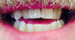 KH After Dental Implants