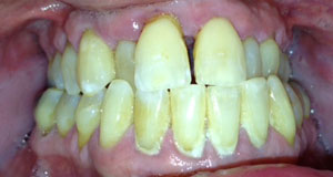 KH Before Dental Implants