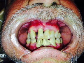 MG Before Teeth-in-a-Day Dental Implants