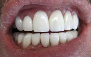 MG After Dental Crowns and Bridges