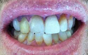 MG Before Dental Crowns and Bridges