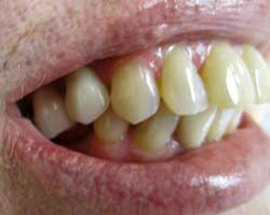 MG After Dental Implants