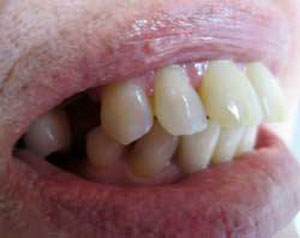 MG Before Dental Implants