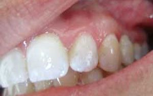 RP After Dental Implants