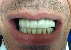 JU After Teeth-in-a-Day Dental Implants