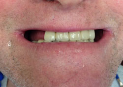 ER Before Teeth-in-a-Day Dental Implants