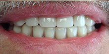 dental-implants-29