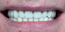 dental-implants-25