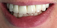 dental-implants-11