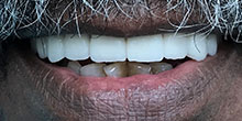 dental-implants-12