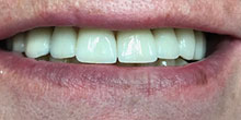 dental-implants-9