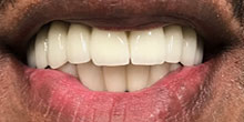 dental-implants-7