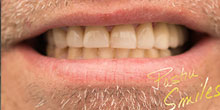 dental-implants-36