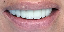 dental-implants-39