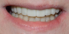 dental-implants-35