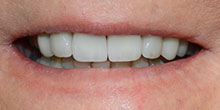 dental-implants-34