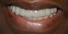 dental-implants-31
