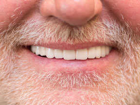 MG After Teeth-in-a-Day Dental Implants