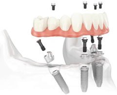 dental implants: all-on-4 implant fixed bridge