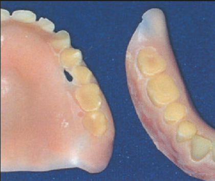 The image show normal wear and tear of dentures after 6 years in use