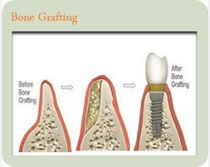 The picture shows a narrow bone left after extensive resorbtion that would not be appropriate in order to place an implant.