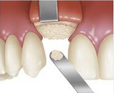 The Procedure of Bone Grafting consists of adding the patient's own bone shavings, cadaver bone or synthetic bone. It is covered then with a membrane and the gums. It takes around 6-9 month to completely heal.