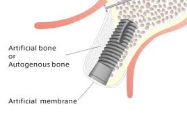 Photo showing the dental implant being partially covered by native jaw bone and partially by bone graft protected by a membrane.