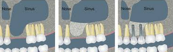 Diadram showing the bone loss corected with the sinus lift procedure and implant placement. Is the sinus lift material going to hold the dental implant as well as the patient's own bone?