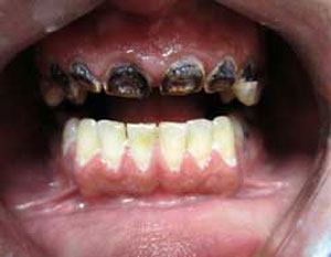 AN Before Dental Implants