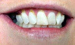 CM Before Porcelain Inlay and Porcelain Veneers & Lumineers