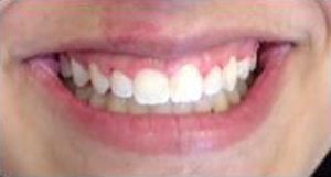 DB After Dental Braces