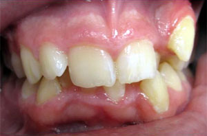 DR Before Dental Braces