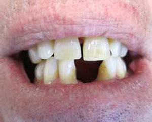 RD Before Dental Implants