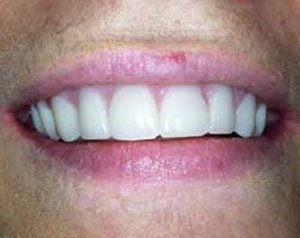 MP After Dental Implants