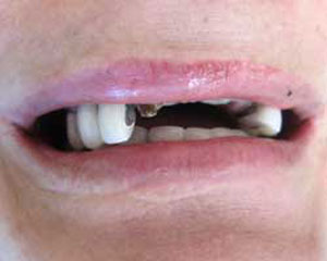 MP Before Dental Implants