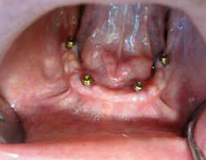 RC Before Dental Implants