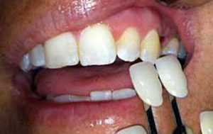 RP Before Dental Implants