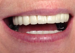 DK After Teeth-in-a-Day Dental Implants