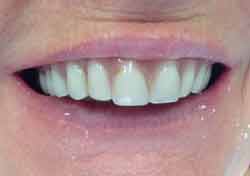 DK Before Teeth-in-a-Day Dental Implants